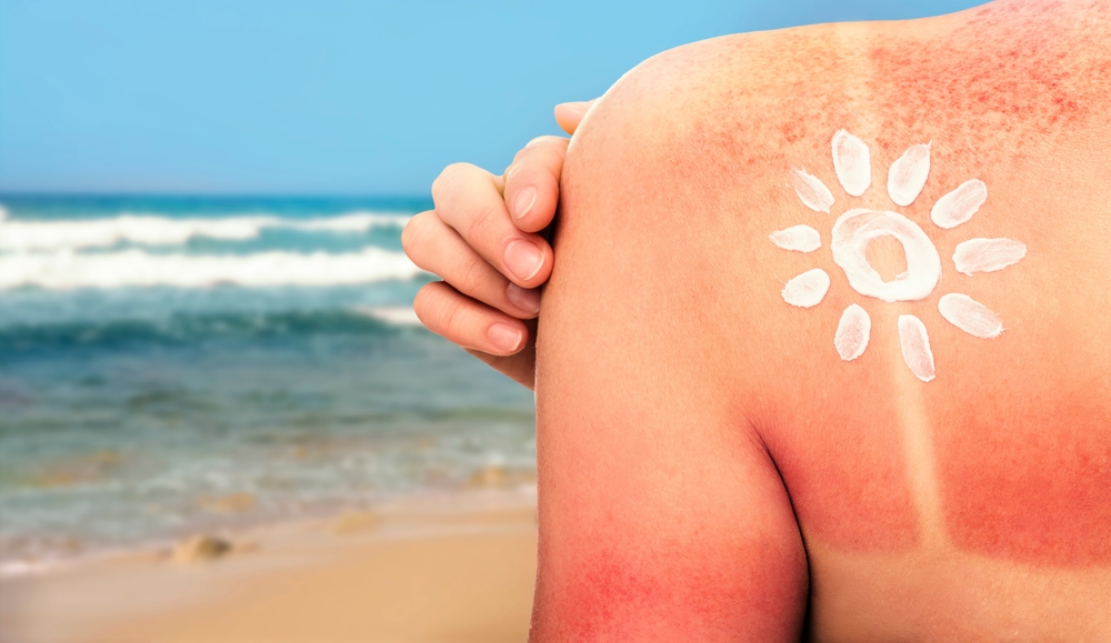 Woman With Sunburned Skin On Beach Back View Soothing Cream
