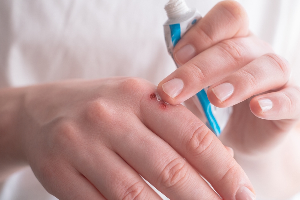 Woman's Hand With A Small Wound Being Treated With Ointment