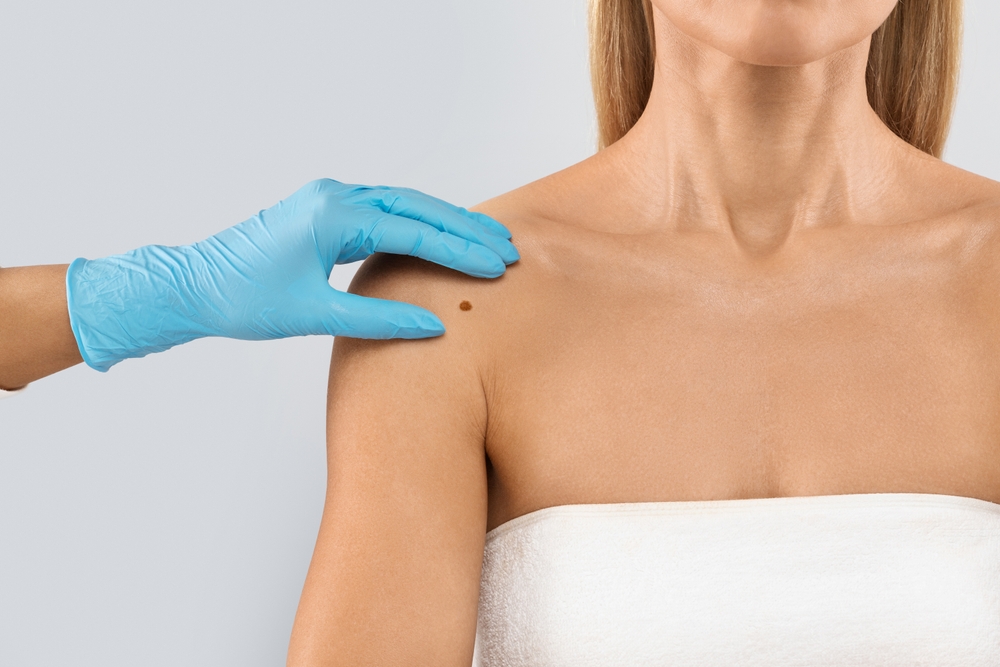The Doctor's Gloved Hand Checking Mole Nevus Unrecognizable Woman's