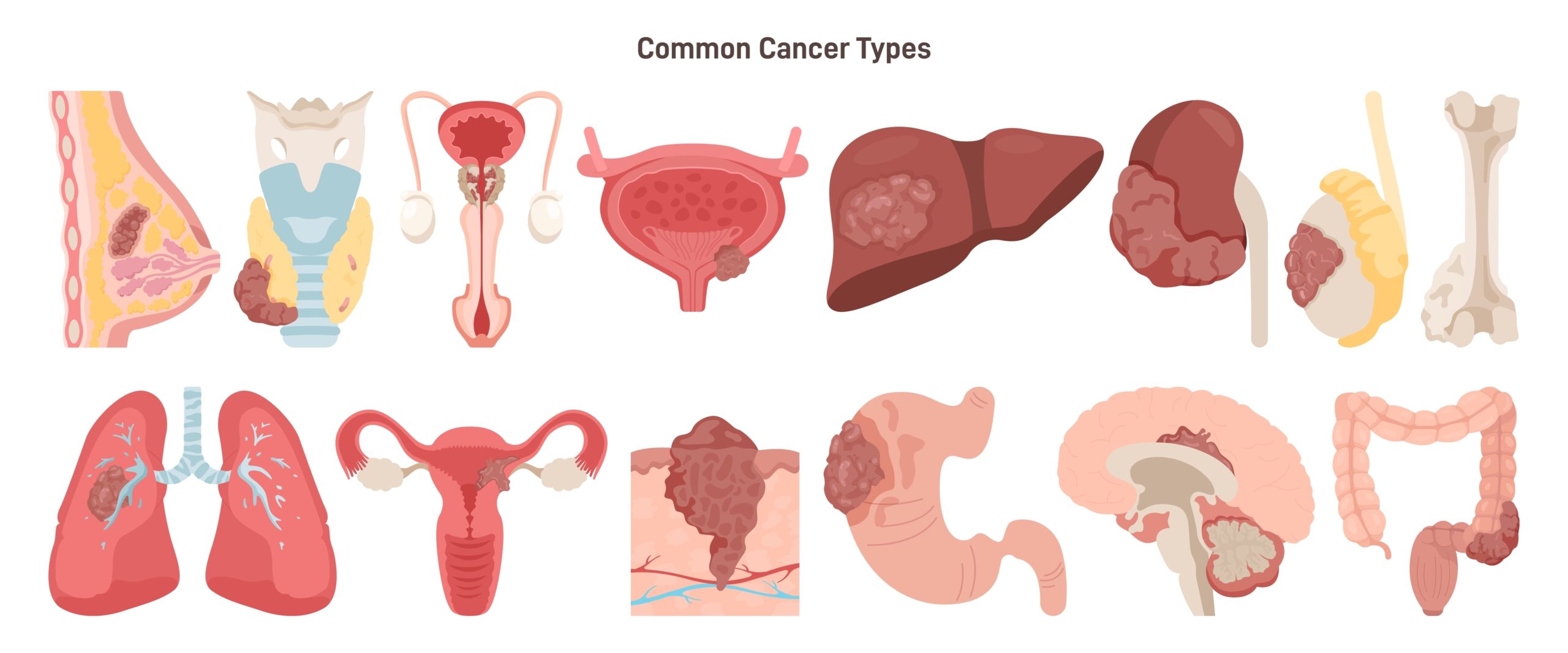 Common Cancer Types Set. Breast Lung Stomach Ovarian Bone Brain