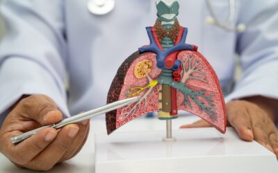 Early Signs & Symptoms of Lung Cancer