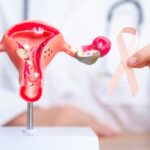 Uterine / Endometrial Cancer: Symptoms, Causes, Stages & Treatment