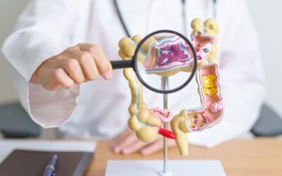 Early Signs & Symptoms of Colorectal / Colon Cancer