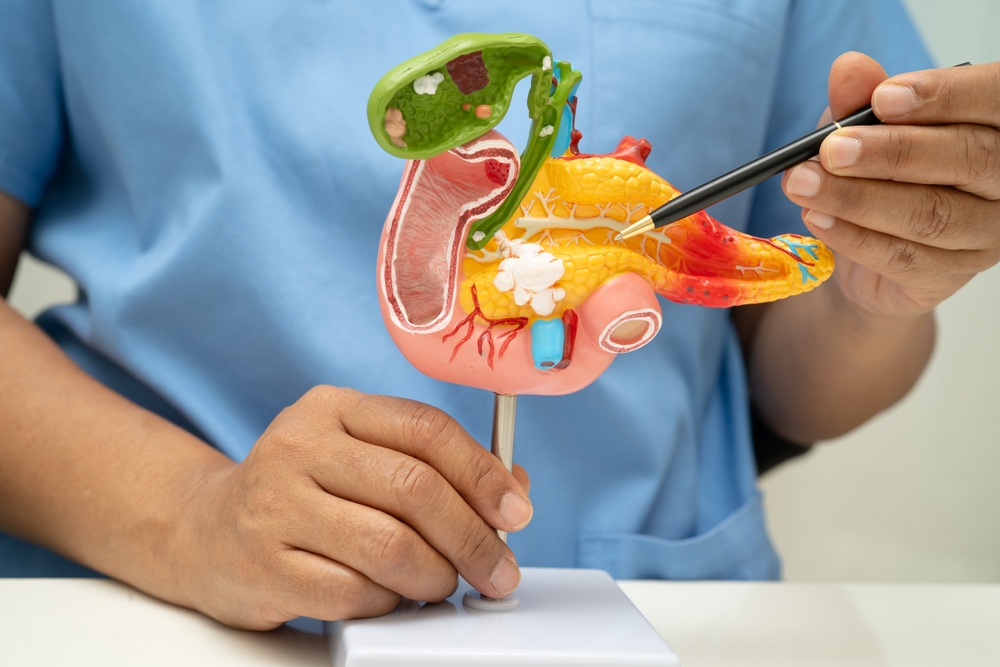 Pancreatitis Pancreatic Cancer Asian Doctor With Pancreas Gallbladder And Bile