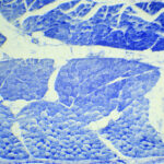 Soft Tissue Sarcoma: Symptoms, Causes, Stages & Treatment