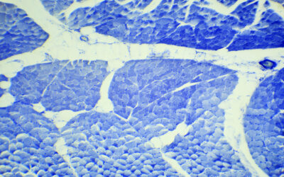 Soft Tissue Sarcoma: Symptoms, Causes, Stages & Treatment